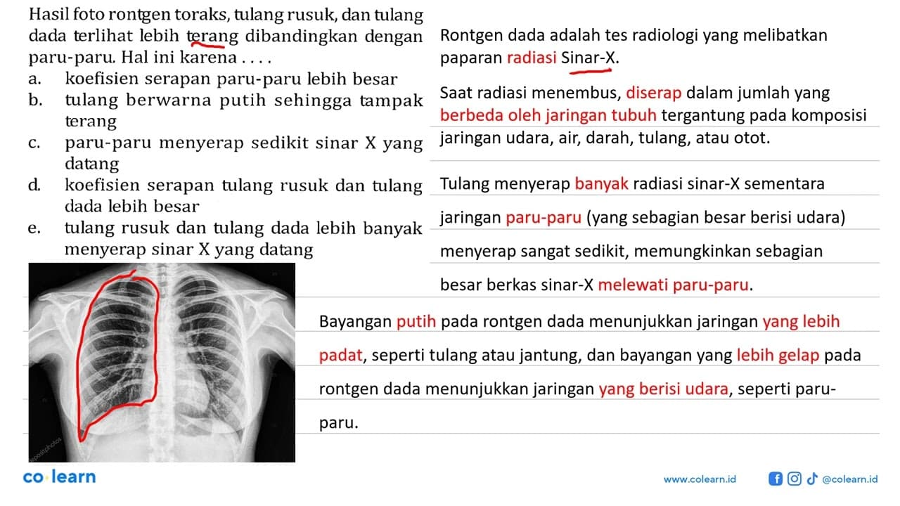 Hasil foto rontgen toraks, tulang rusuk, dan tulang dada