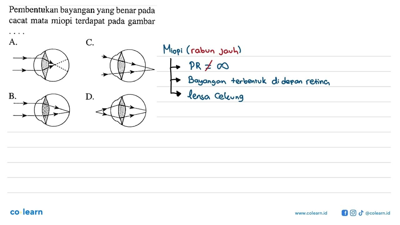 Pembentukan bayangan yang benar pada cacat mata miopi