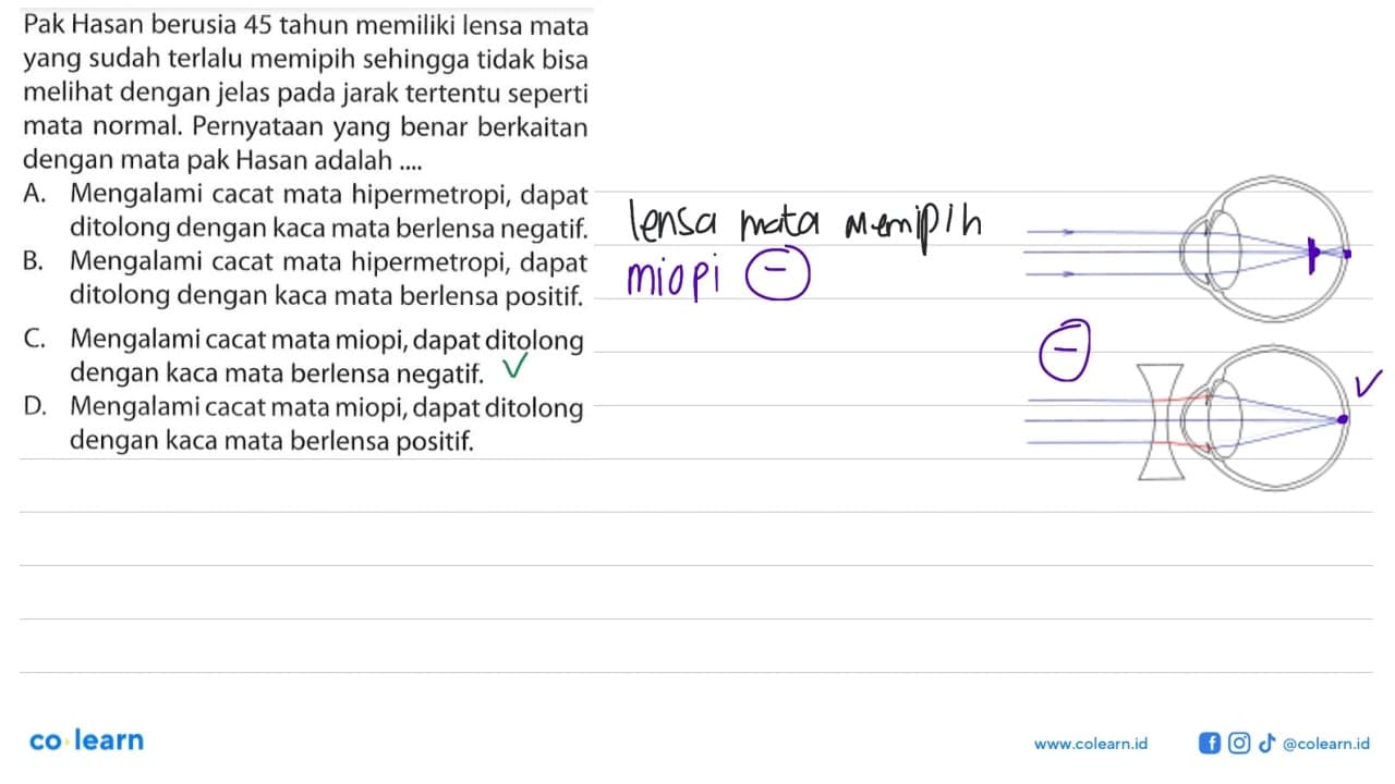 Pak Hasan berusia 45 tahun memiliki lensa mata yang sudah